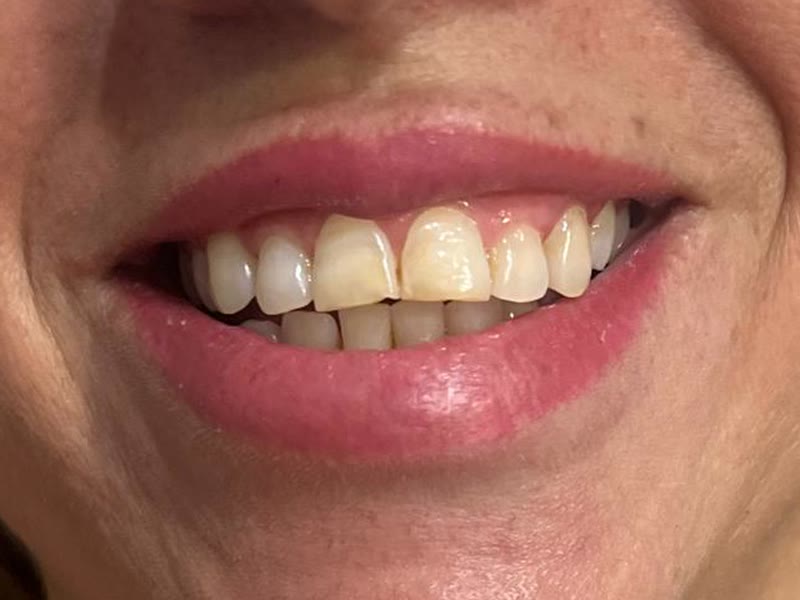 Antes: dentes amarelados e de tamanhos diferentes