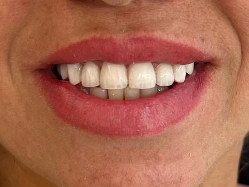 Depois: sorriso com lentes, dentes claros e alinhados